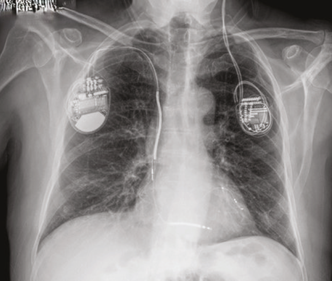both pacemakers are seen on the chest X-ray.